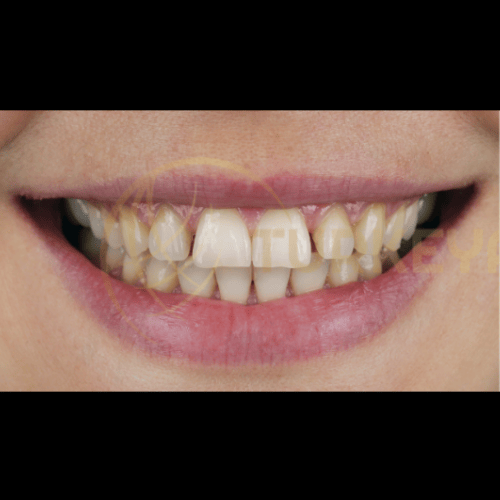 Teeth Whitening in istanbul