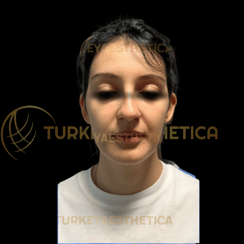 Otoplasty Surgery in İstanbul Prices