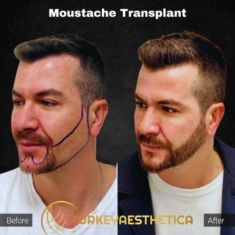 Moustache Transplant in istanbul